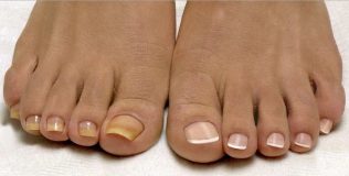 nail fungus